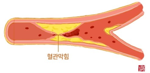 05_중성지방은-혈관건강을-나쁘게-하나요.jpg