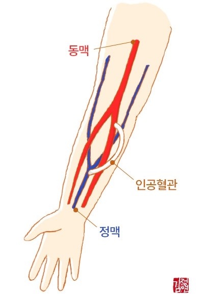 98인공혈관은 무엇인가요.jpg